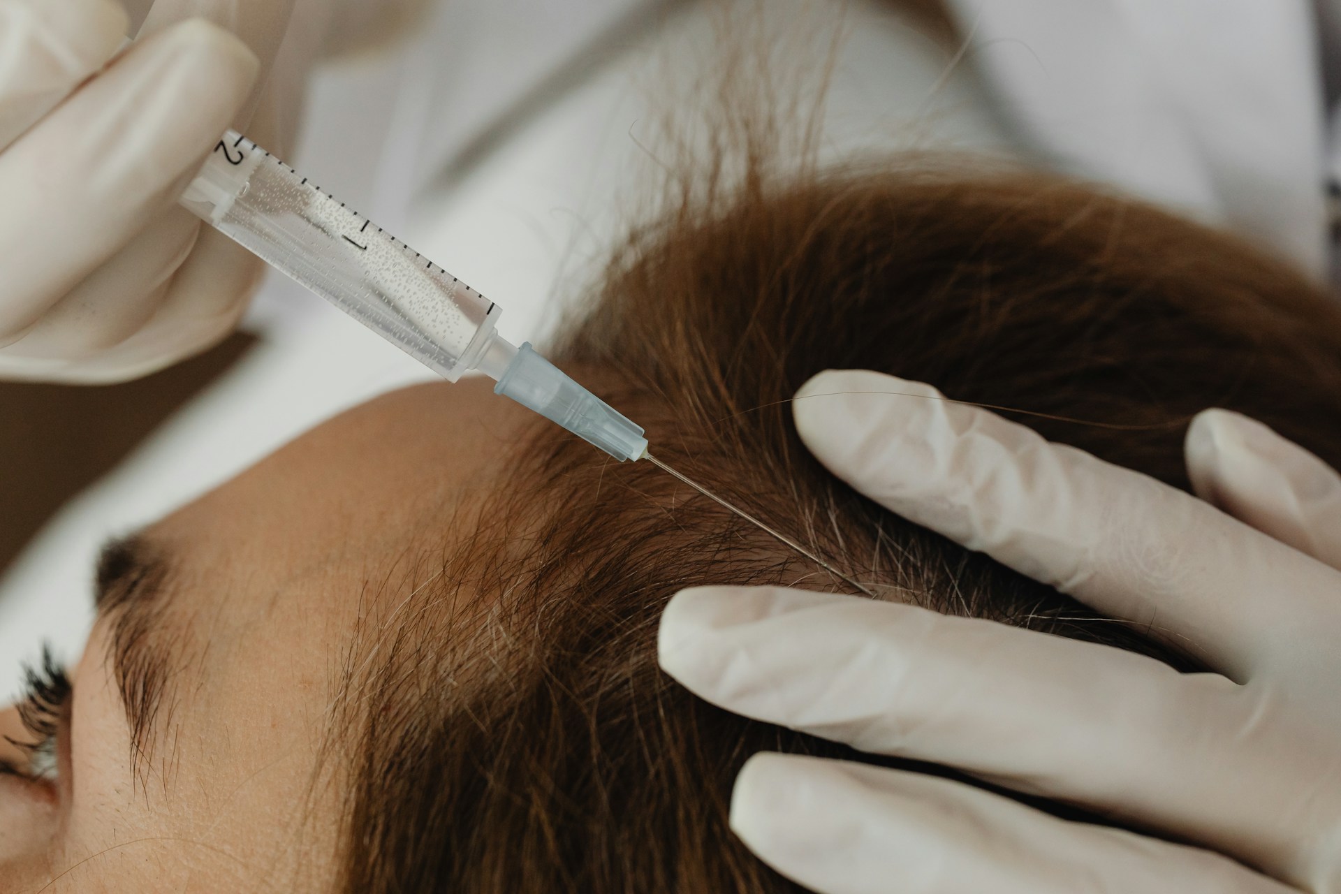 PRP Tricologia